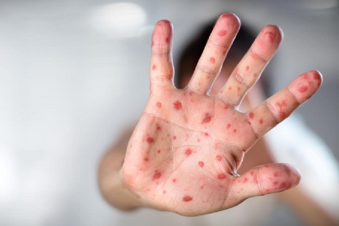 rubella