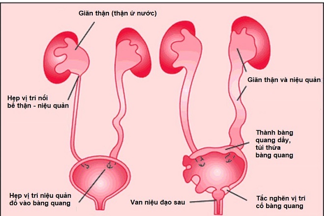 Giãn bể thận ở thai nhi