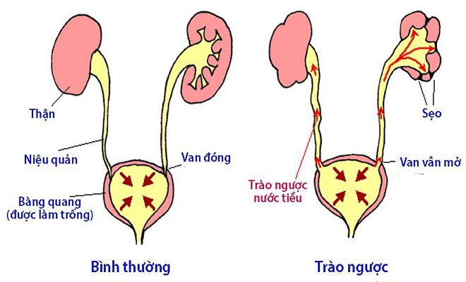 trào ngược