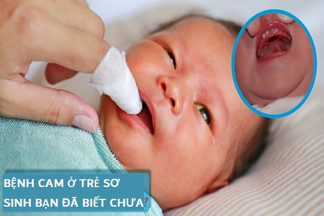Bệnh cam ở bé