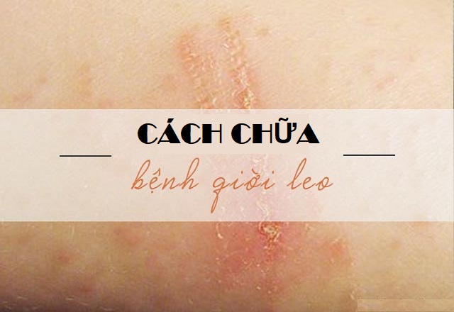 Phòng tránh bệnh giời leo