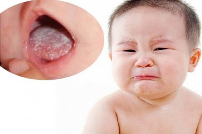chữa trị bệnh nhiệt miệng