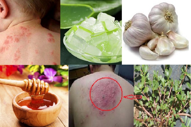 trị bệnh dân gian