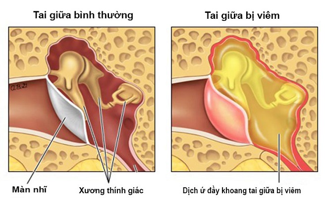 giai đoạn bệnh