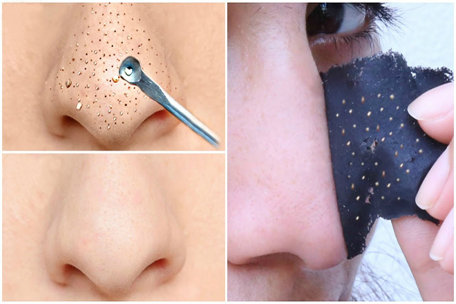 Cách trị mụn đầu đen