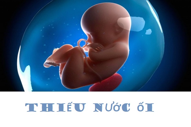 thiếu nước ối