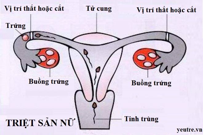 phương pháp triệt sản