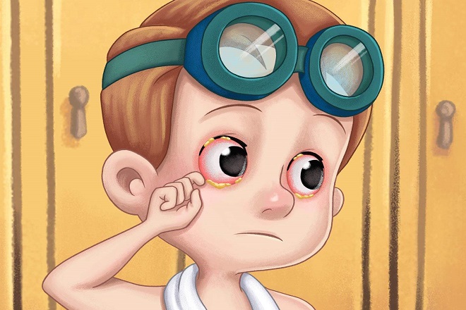 Viêm kết mạc