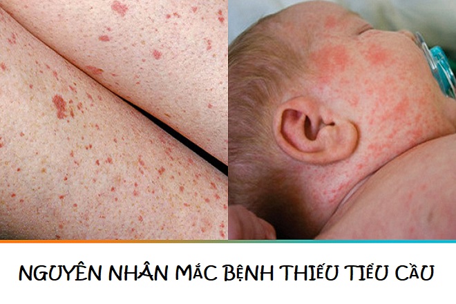 Nguyên nhân mắc bệnh