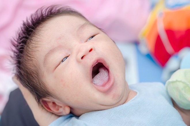 Bệnh đẹn ở trẻ sơ sinh