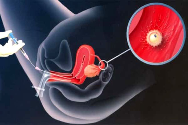 IUI_Yeutre.vn