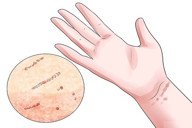 dấu hiệu của bệnh