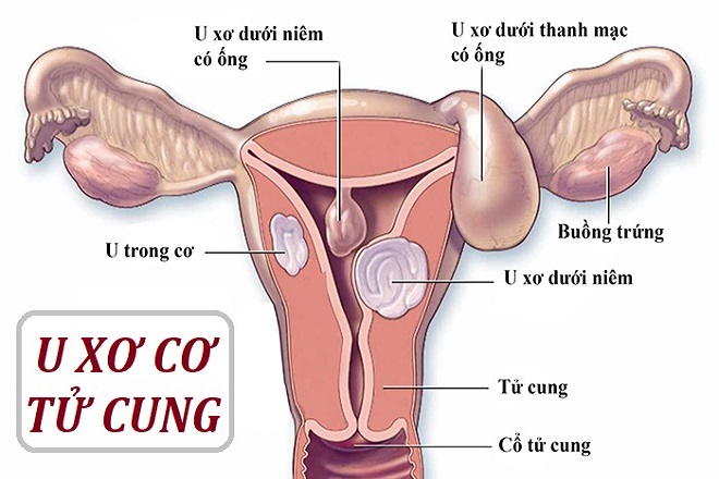 nhân xơ tử cung