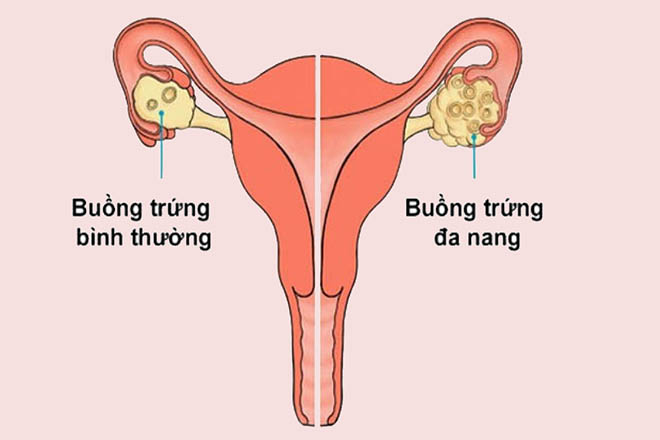 Buồng trứng đa nang