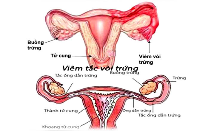 Tắc ống dẫn trứng