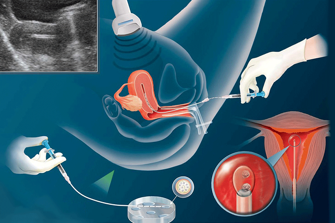 iui