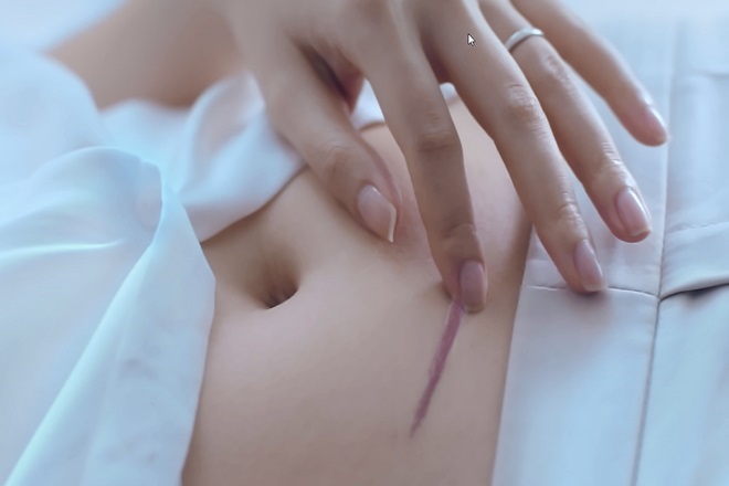 phương pháp sinh mổ