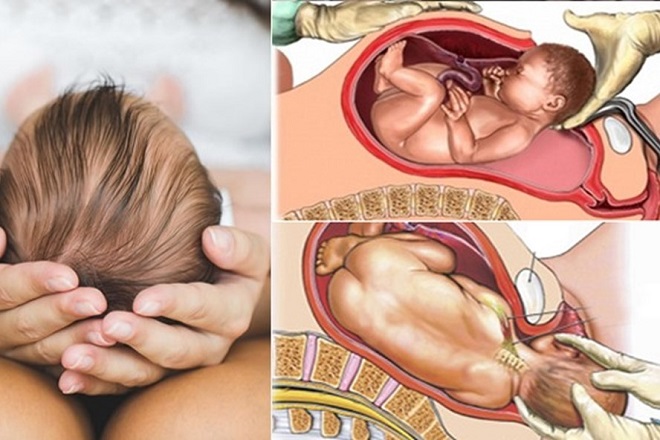 tác hại của sinh mổ