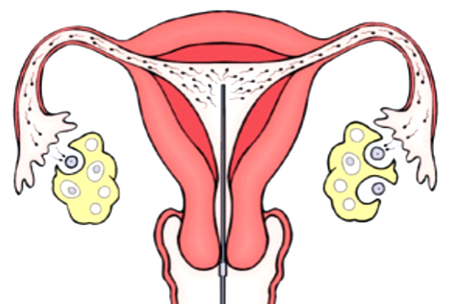 IUI tăng tối đa tinh trùng