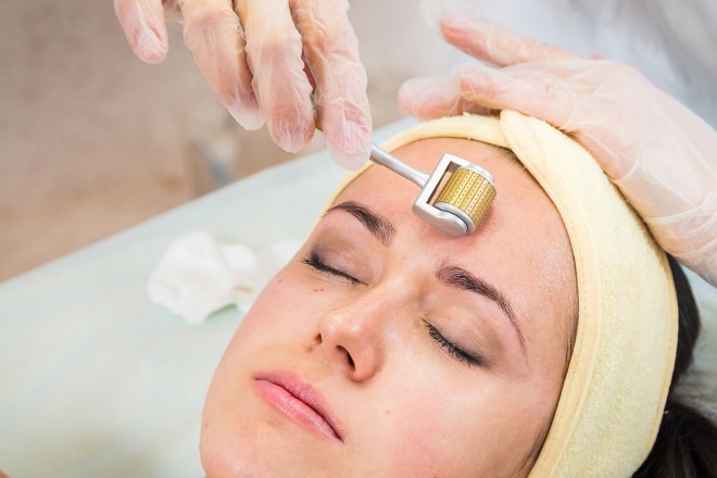 Lăn kim trị sẹo được xem là phương pháp