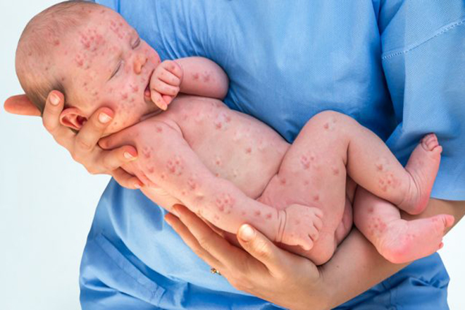 Bệnh thủy đậu ở trẻ