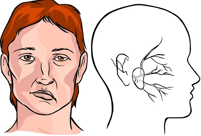 biểu hiện của bệnh đột quỵ