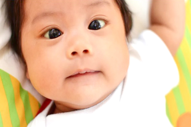 Bé bị mắt lác