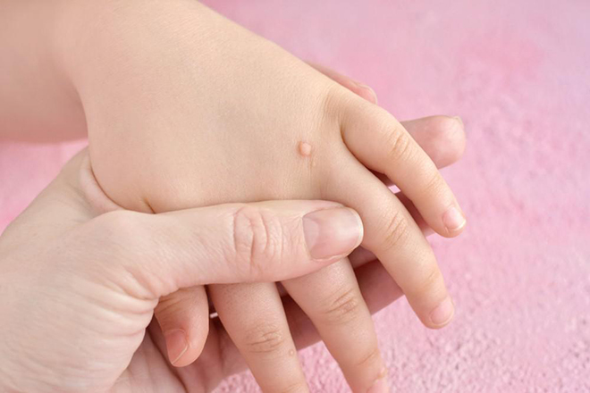 Tay bé bị mụn cóc