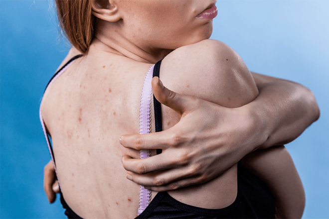 Các loại mụn lưng thường gặp