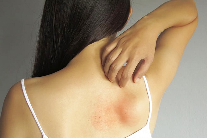 Bệnh rôm sảy