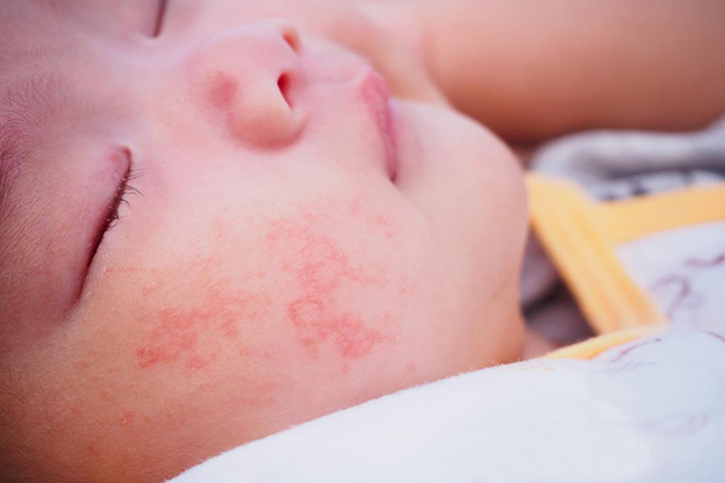 Bé sơ sinh bị dị ứng sữa