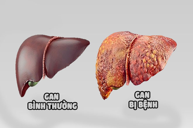 Tình trạng lá gan