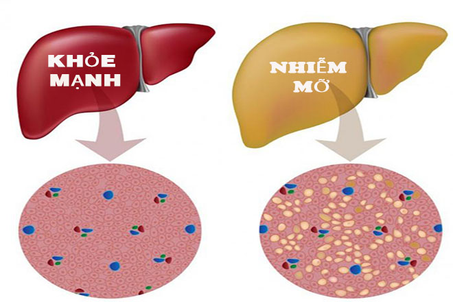 Gan nhiễm mỡ