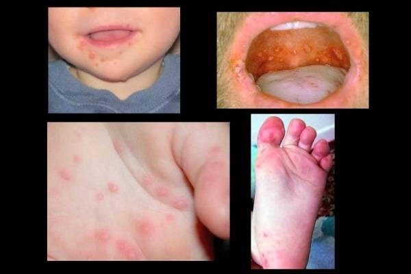Cách nhận biết bệnh tay chân miệng ở trẻ sớm nhất