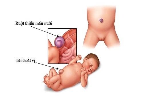Những điều cần lưu ý khi trẻ sơ sinh bị thoát vị rốn