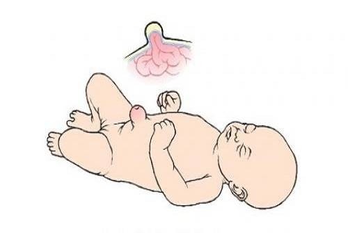 Những điều cần lưu ý khi trẻ sơ sinh bị thoát vị rốn