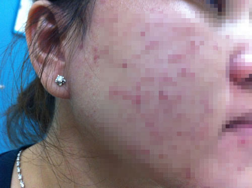 lam dep khac nguoi co gai tre nhap vien voi khuon mat bi bien dang lam dep khac nguoi co gai tre nhap vien voi khuon mat bi bien dang viem da.jpg