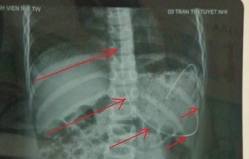 xot xa nguoi bo luc bat tong tam nhin con 5 tuoi gong minh chong bao benh benh nhi3.jpg