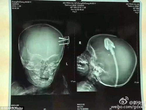 dang choi tren giuong bi nga xuong dat be trai 2 tuoi bi phich dien cam xien vao nao 3a3449cf00000578 0 image a 18_1478700299229.jpg