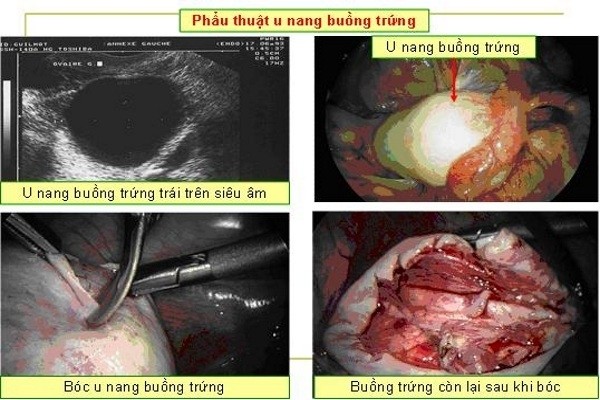 u nang buong trung 3