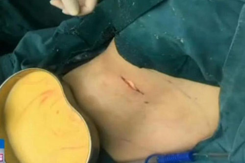 bung to bat thuong sau khi don nguc nguoi phu nu chet ngat khi biet ly do 4.jpg