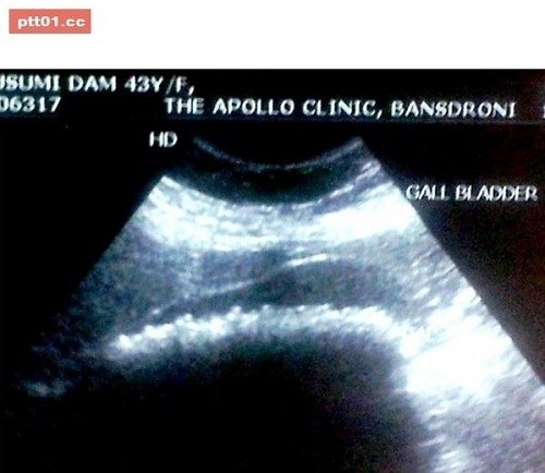 bac si so hai loai bo 360 vien soi trong co the co gai sau 1 gio phau thuat 1.jpg