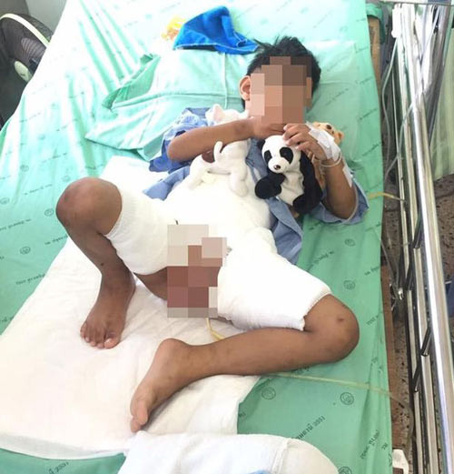 be trai 5 tuoi bi cha me danh dap do nuoc soi vao hang 3.jpg
