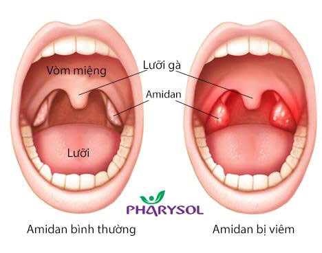 viem amidan co the chua khoi ma khong can cat bo chua amidan 2 .jpg